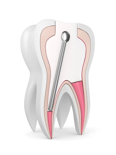 Render Tand Med Rostfritt Stål Dentala Post Och Fyllning Över — Stockfoto