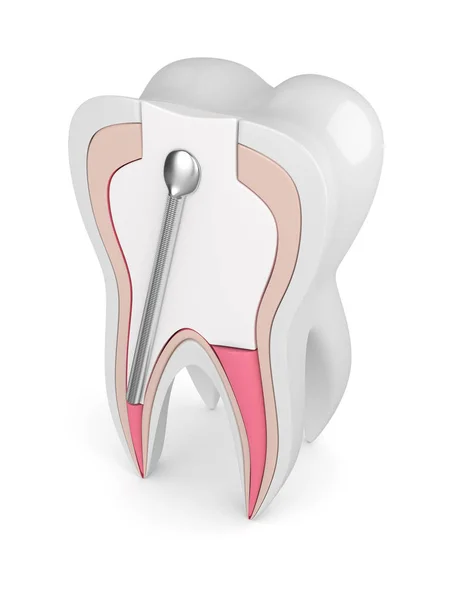 Renderização Dente Com Poste Dental Aço Inoxidável Enchimento Sobre Fundo — Fotografia de Stock