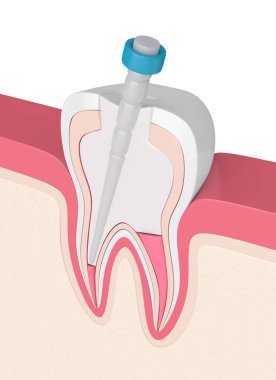 3d render of tooth with gutta percha, fiber post and filling in gums. Endodontic treatment concept clipart
