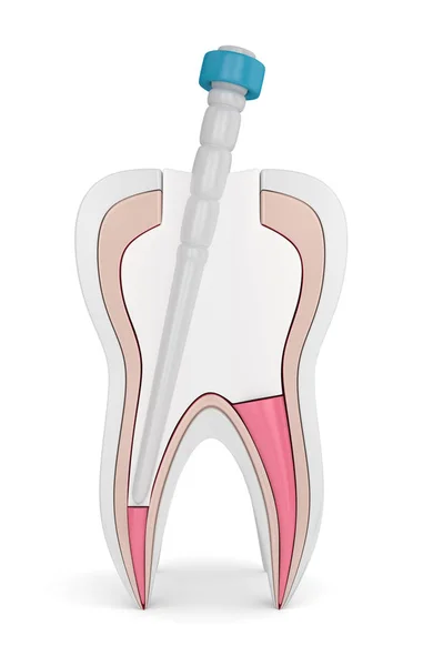 Gutta Percha 포스트와 작성의 렌더링 Endodontic — 스톡 사진