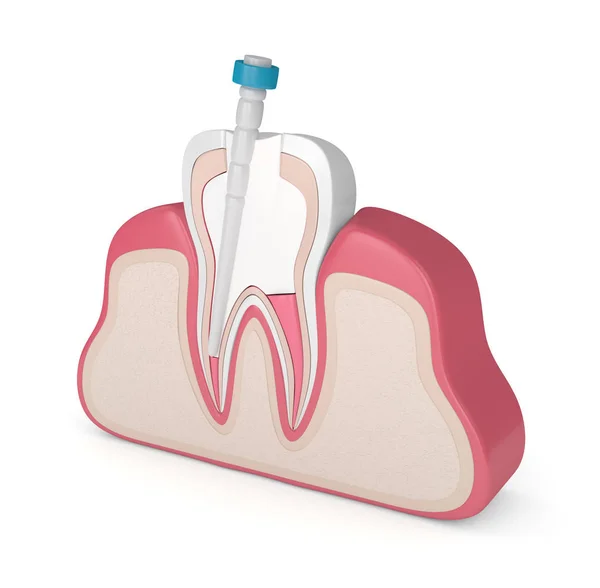 ガッタバーチャ ファイバーポスト 歯茎で充填歯の のレンダリング 歯内治療コンセプト — ストック写真