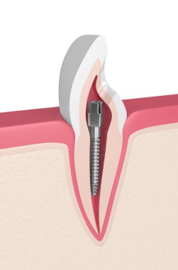 kesici diş diş etleri diş metal yazı ile 3D render. Endodontik tedavi kavramı