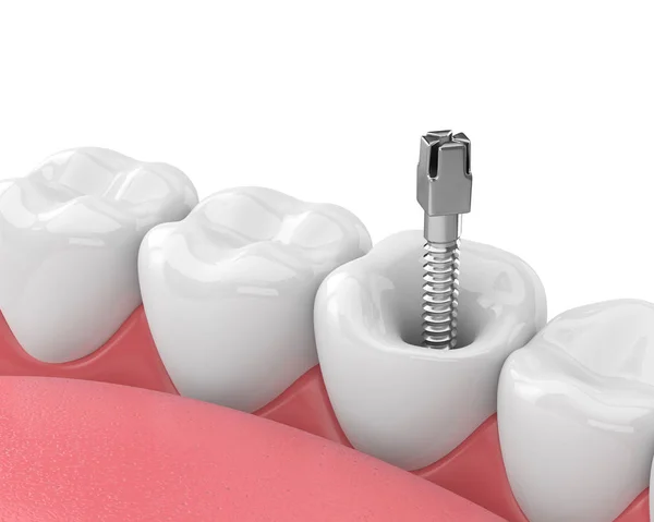 Renderização Mandíbula Com Dentes Pino Metal Dental Sobre Branco Conceito — Fotografia de Stock