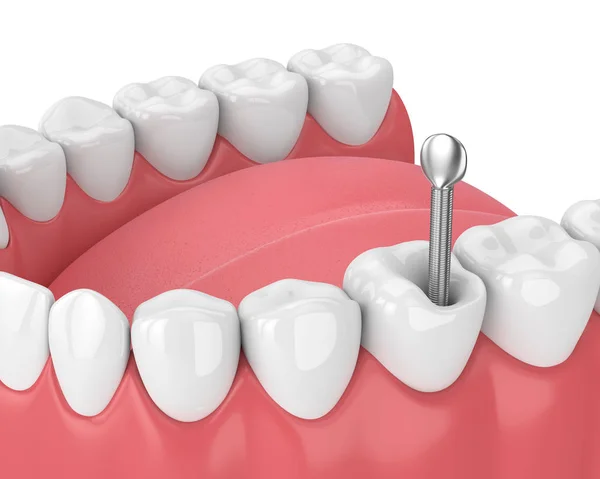Render Szczęki Zębów Stomatologiczne Post Metal Białym Koncepcja Leczenie Endodontyczne — Zdjęcie stockowe