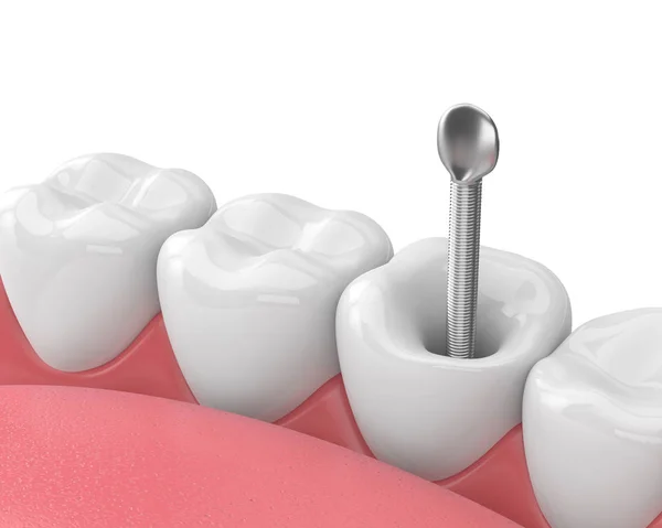 Render Szczęki Zębów Stomatologiczne Post Metal Białym Koncepcja Leczenie Endodontyczne — Zdjęcie stockowe