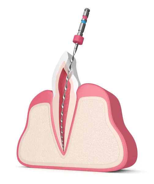 在牙龈中用根管文件进行牙齿渲染 根管治疗概念 — 图库照片