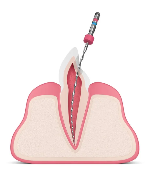 Renderização Dente Com Arquivo Endodôntico Gengivas Conceito Tratamento Canal Radicular — Fotografia de Stock