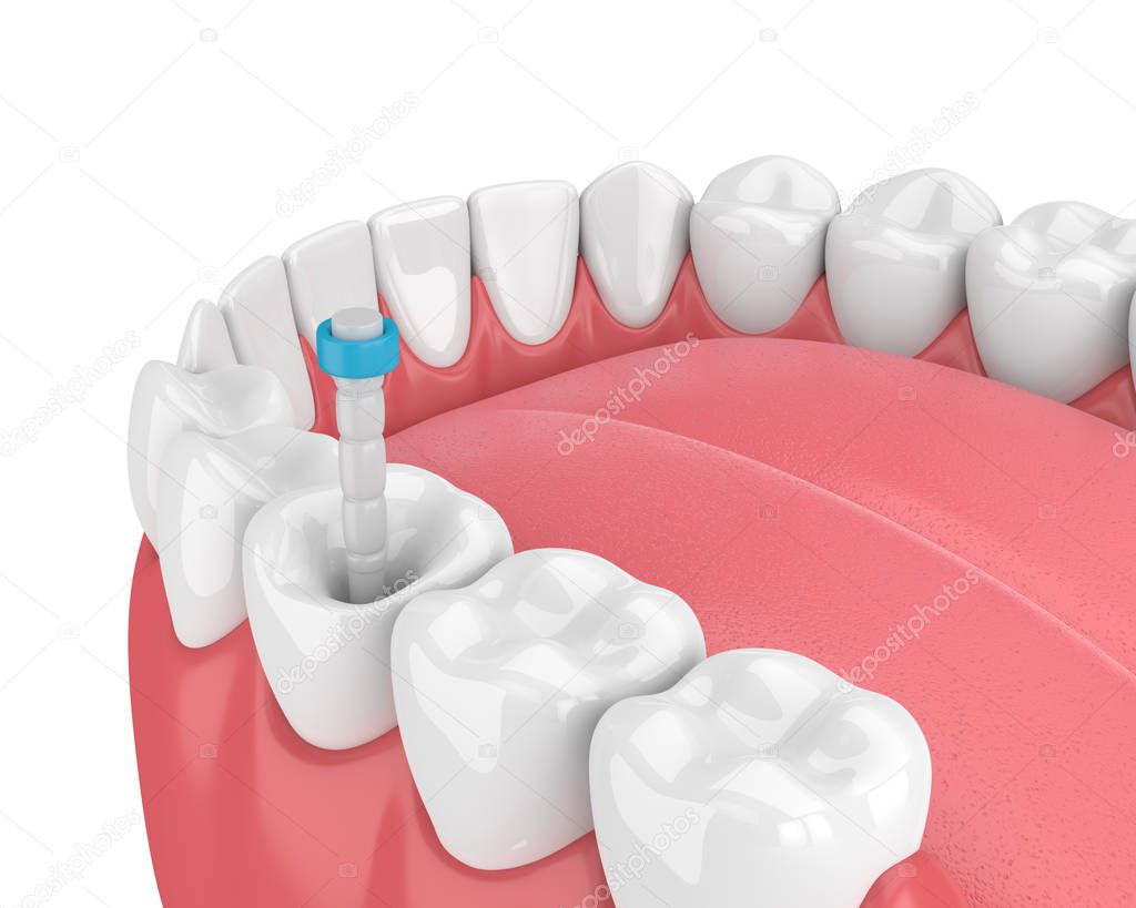 3d render of jaw with teeth and fiber post over white. Endodontic treatment concept