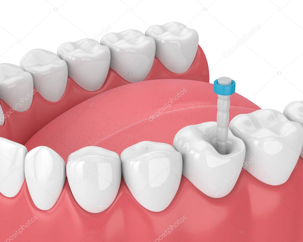 3d render of jaw with teeth and fiber post over white. Endodontic treatment concept