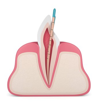 kesici diş etleri beyaz arka plan üzerinde gutta percha ile 3D render. Endodontik tedavi kavramı.