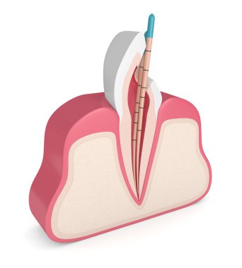 kesici diş etleri beyaz arka plan üzerinde gutta percha ile 3D render. Endodontik tedavi kavramı.