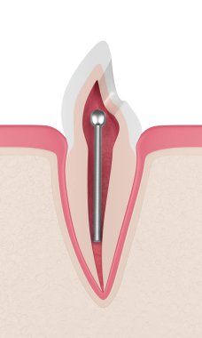 3D render diş diş etleri diş paslanmaz çelik yazı ile. Endodontik tedavi kavramı