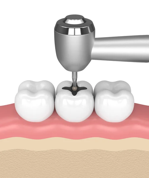 Renderizado Encías Con Dientes Pieza Mano Dental Taladro Aislado Sobre — Foto de Stock