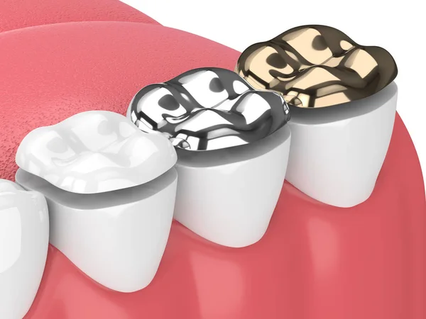 Render Jaw Teeth Three Types Onlay White — Stock Photo, Image