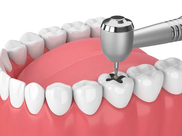 Renderização Mandíbula Com Dentes Handpiece Dental Broca Isolada Sobre Branco — Fotografia de Stock