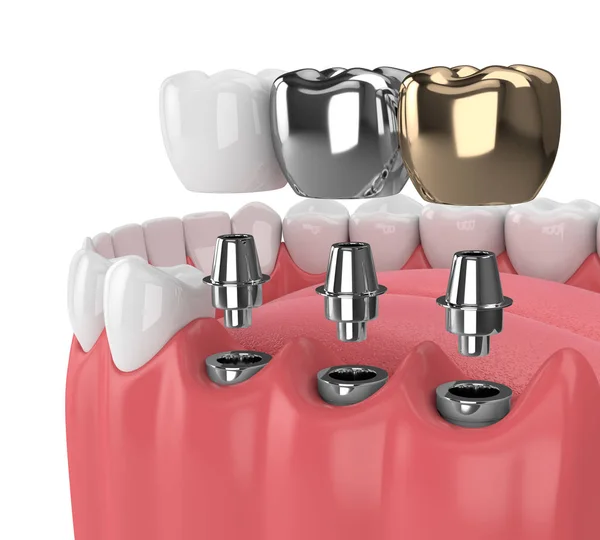 Resa Della Mascella Con Denti Tre Tipi Impianti Bianco — Foto Stock