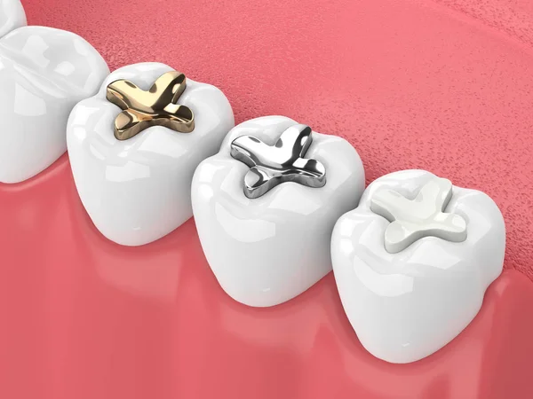 Render Jaw Teeth Three Types Inlay White — Stock Photo, Image