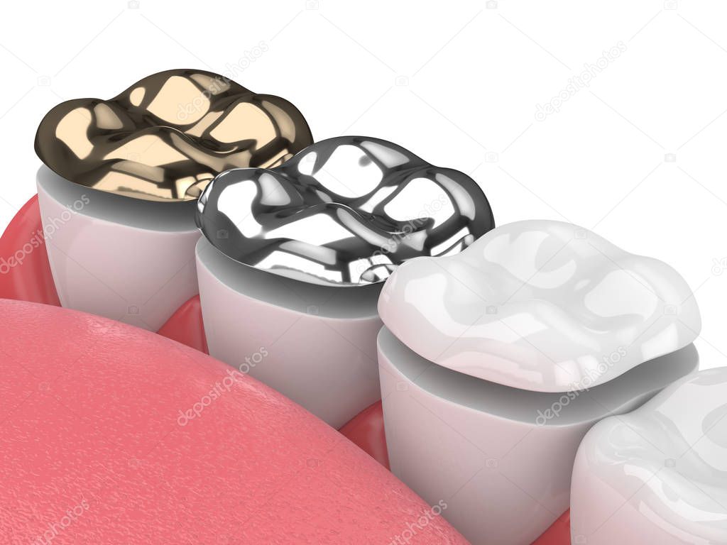 3d render of jaw with teeth and three types of onlay over white