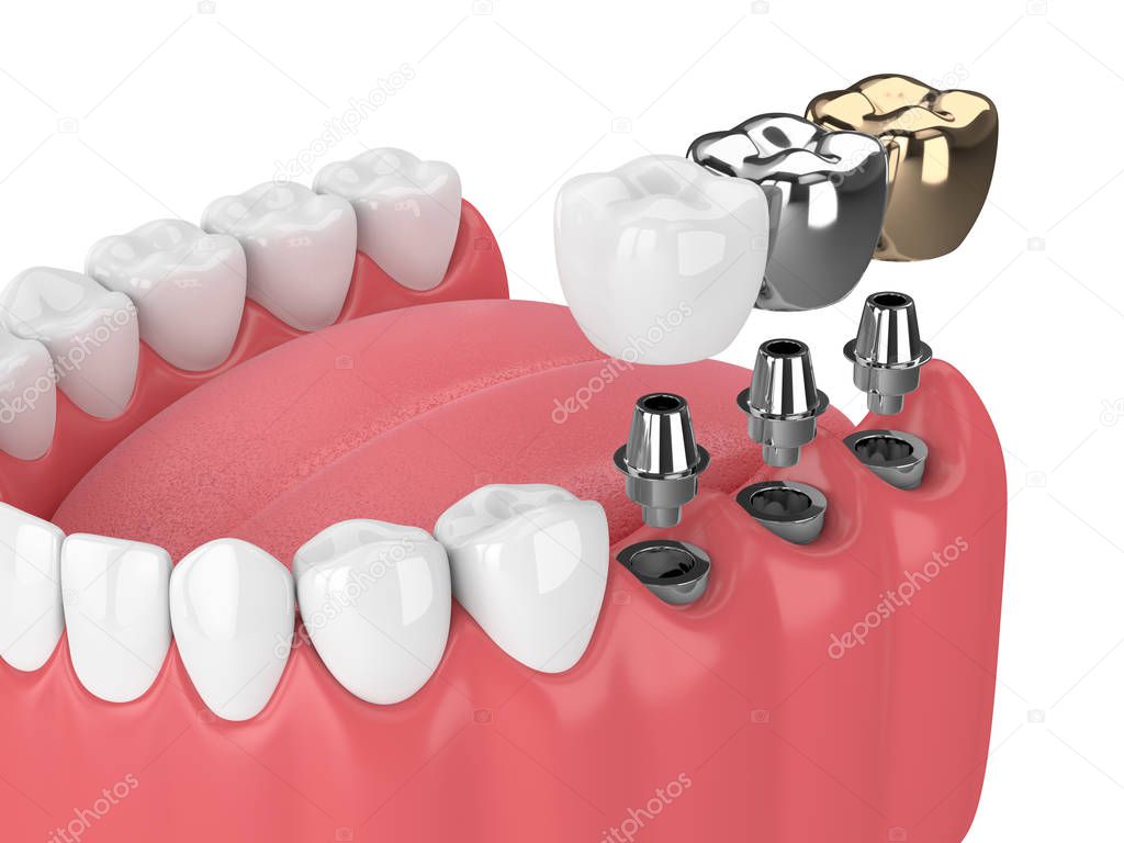 3d render of jaw with teeth and three types of implants over white