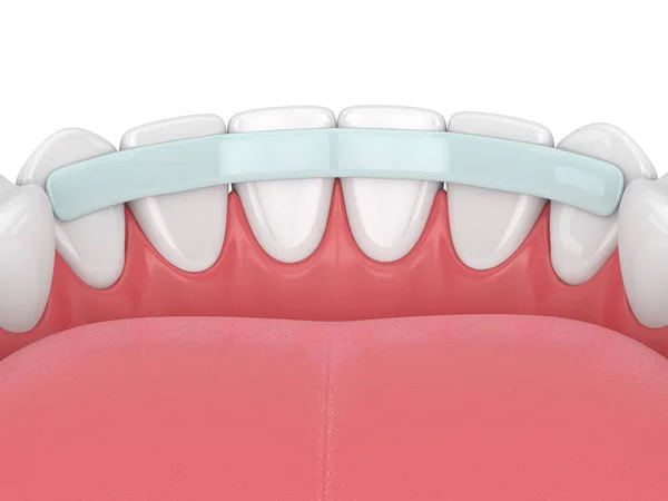 Renderização Dentes Com Fibra Reforço Dental Sobre Branco — Fotografia de Stock