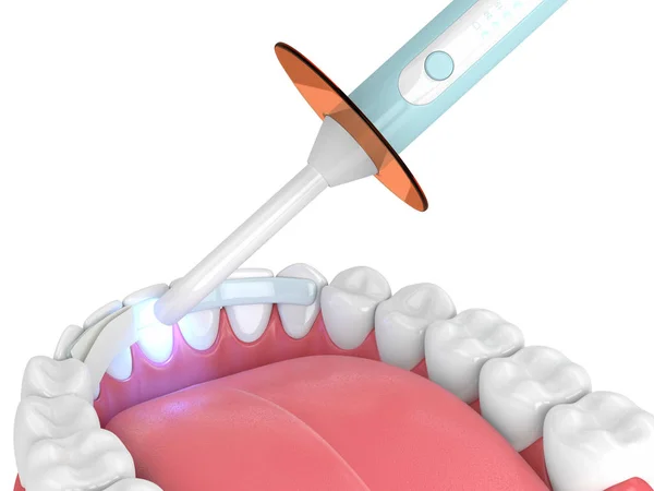 Rendering Della Mascella Con Lampada Polimerizzazione Dentale Fibra Dentale Sfondo — Foto Stock