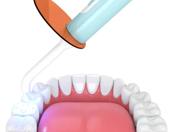 Renderização Mandíbula Com Lâmpada Polimerização Dental Luz Curada Enchimento Inlay — Fotografia de Stock