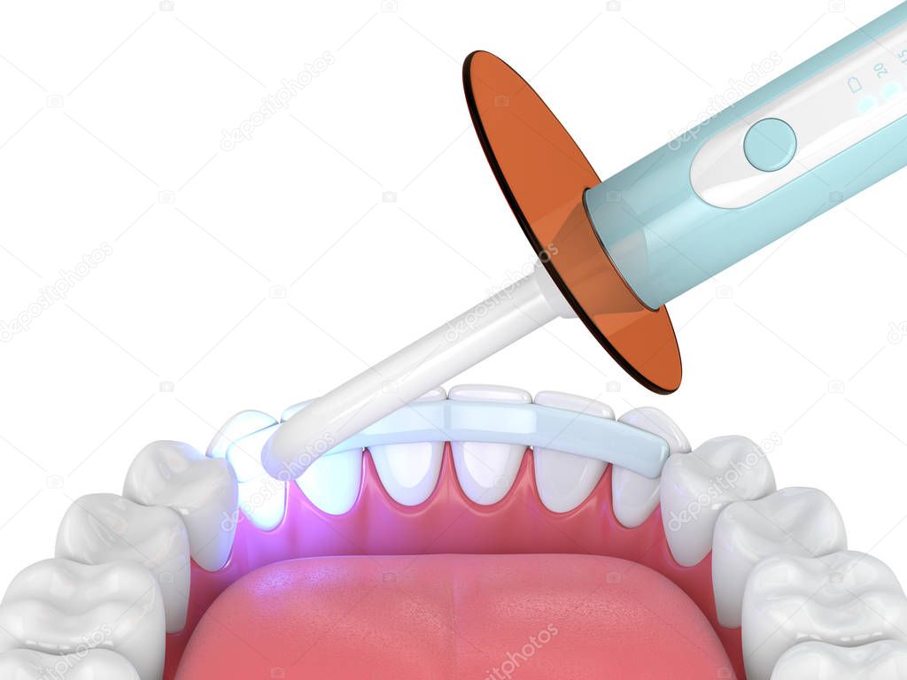 3d render of jaw with dental polymerization lamp and dental fiber over white background