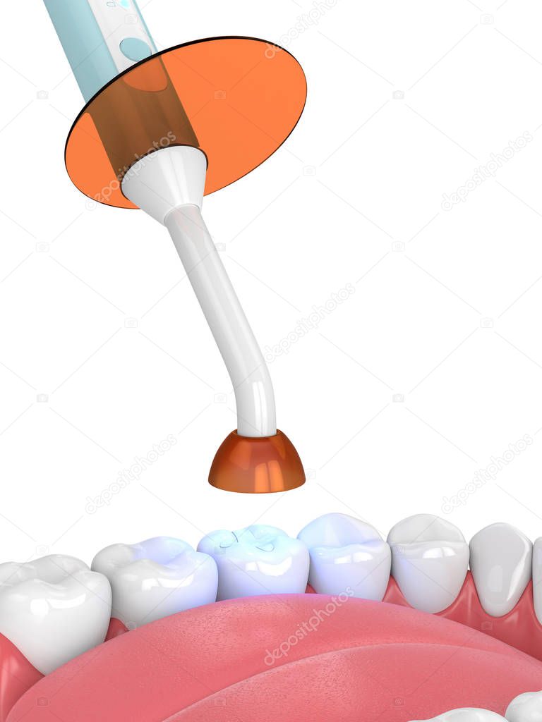 3d render of jaw with dental polymerization lamp and light cured inlay filling over white background