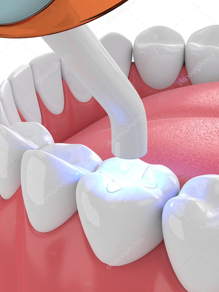 3d render of jaw with dental polymerization lamp and light cured inlay filling over white background
