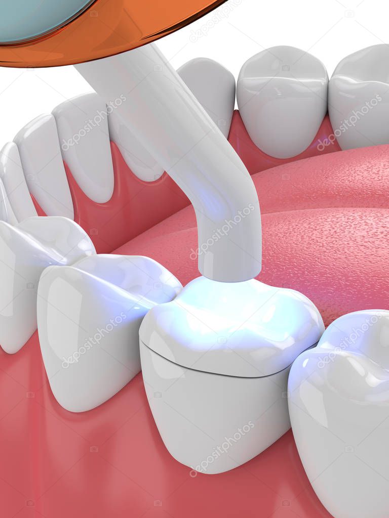 3d render of jaw with dental polymerization lamp and light cured onlay filling over white background