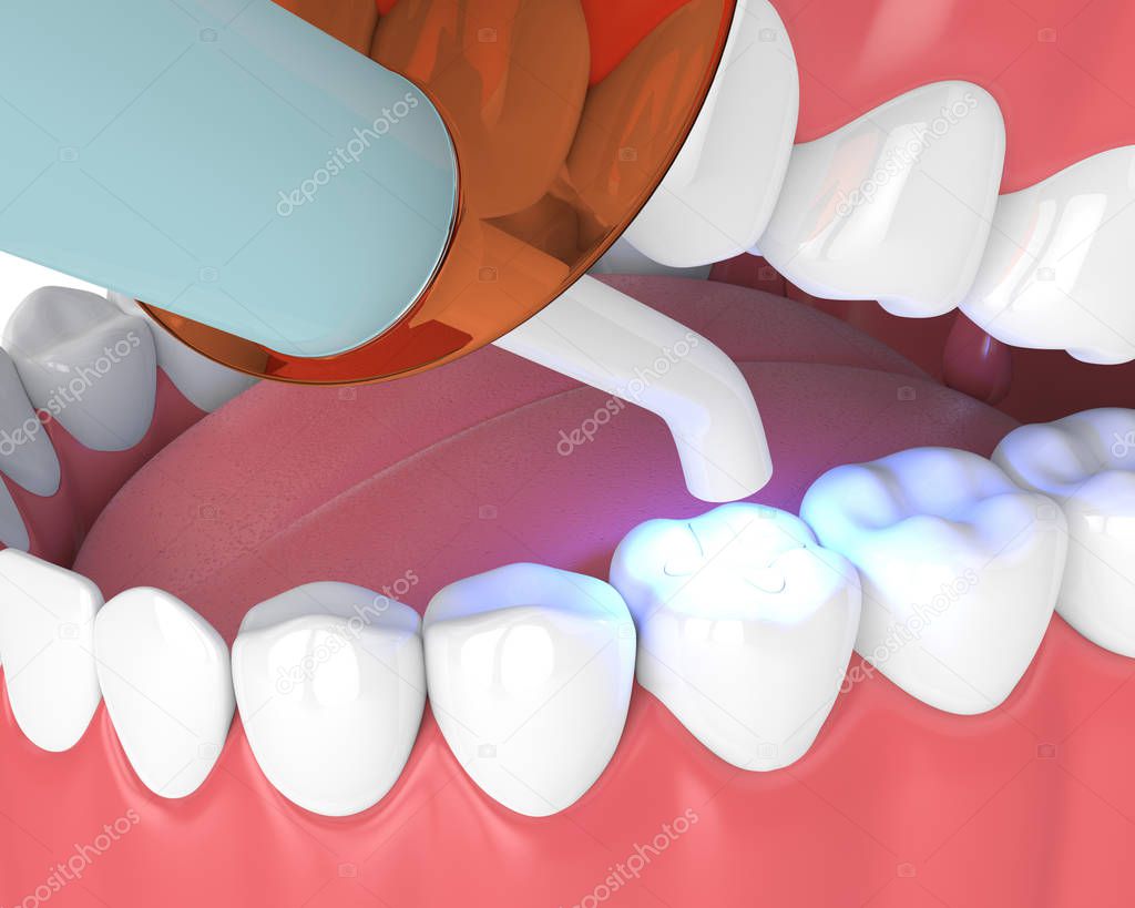 3d render of jaw with dental polymerization lamp and light cured inlay filling over white background