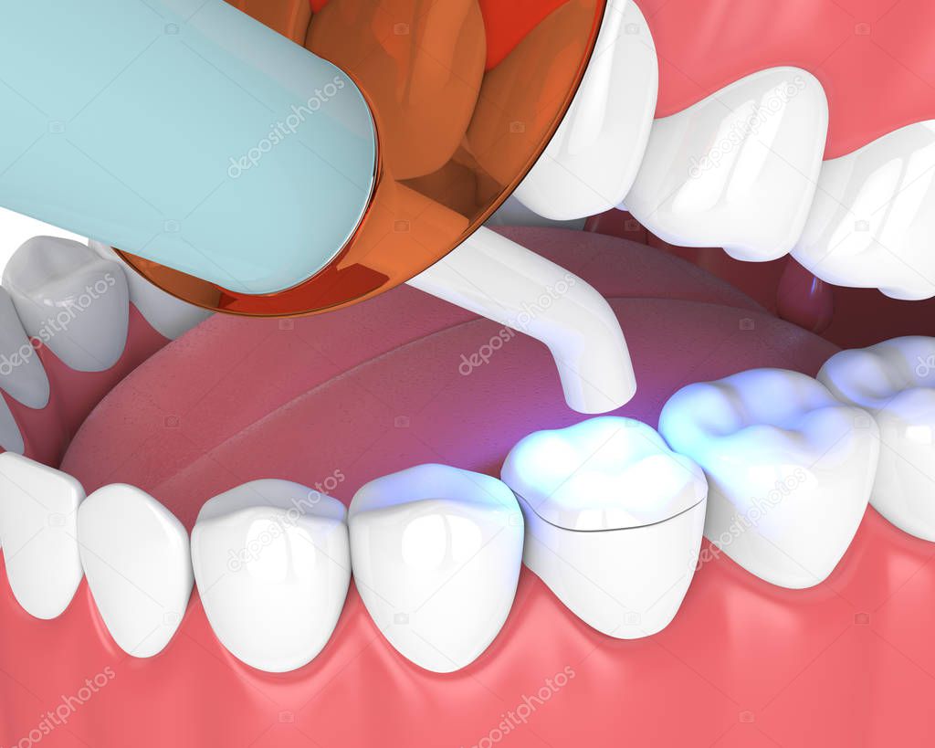 3d render of jaw with dental polymerization lamp and light cured onlay filling over white background