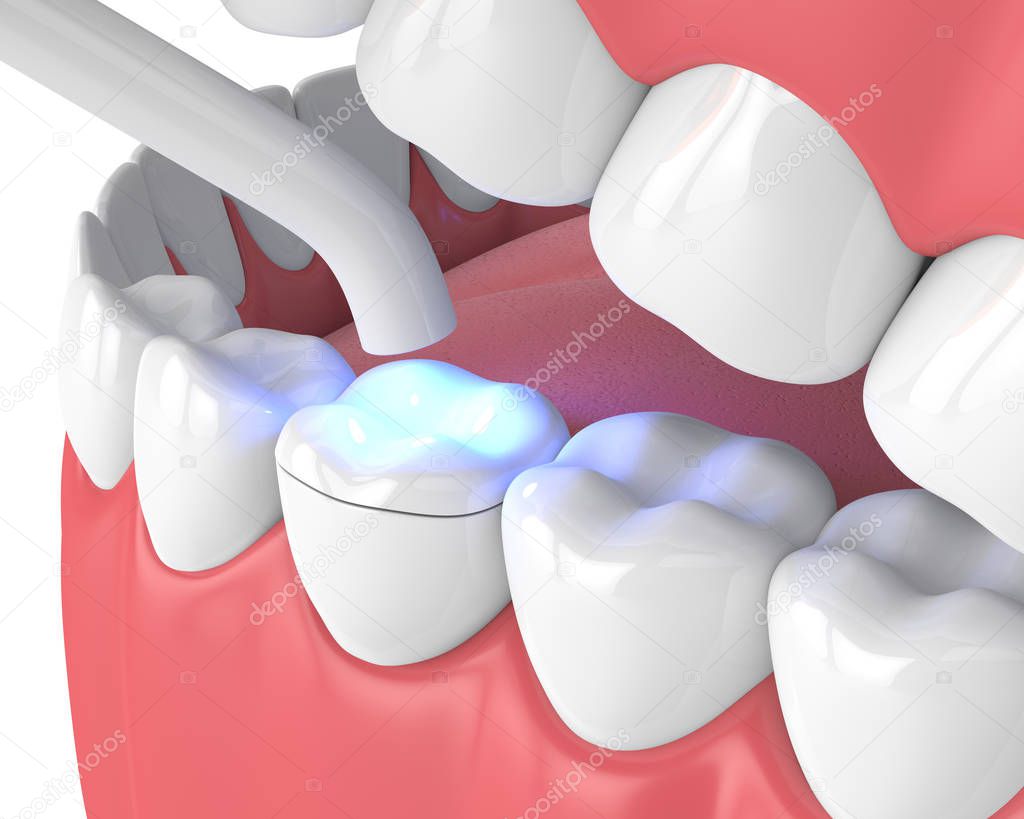 3d render of jaw with dental polymerization lamp and light cured onlay filling over white background