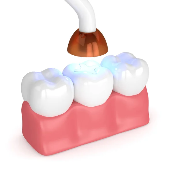 Rendering Der Zähne Mit Zahnpolymerisationslampe Und Lichthärtender Inlay Füllung Auf — Stockfoto