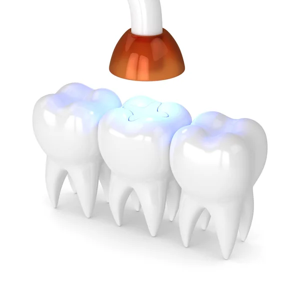 Odwzorowania Zębów Dentystycznych Polimeryzacji Lampy Światła Peklowane Wkładka Napełniania Białym — Zdjęcie stockowe