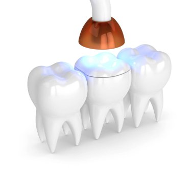 3d render of teeth with dental polymerization lamp and light cured onlay filling over white background clipart
