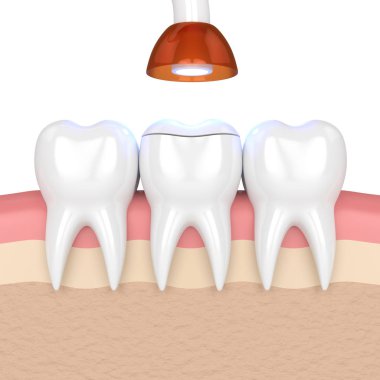3d render of teeth with dental polymerization lamp and light cured onlay filling over white background clipart