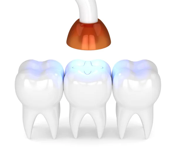 Render Tänder Med Dentala Polymerisation Lampa Och Ljus Lufttorkad Inlaga — Stockfoto
