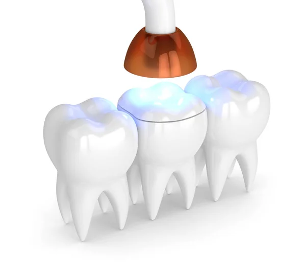 Рендеринг Зубов Помощью Лампы Полимеризации Зубов Светлого Накладного Покрытия Белом — стоковое фото