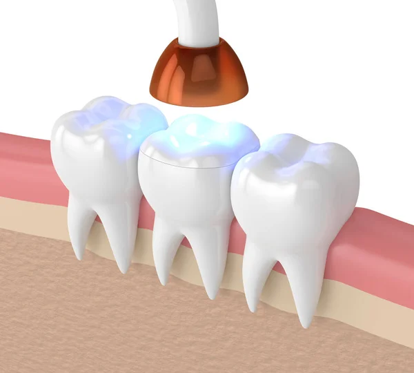 3d render of teeth with dental polymerization lamp and light cured onlay filling over white background