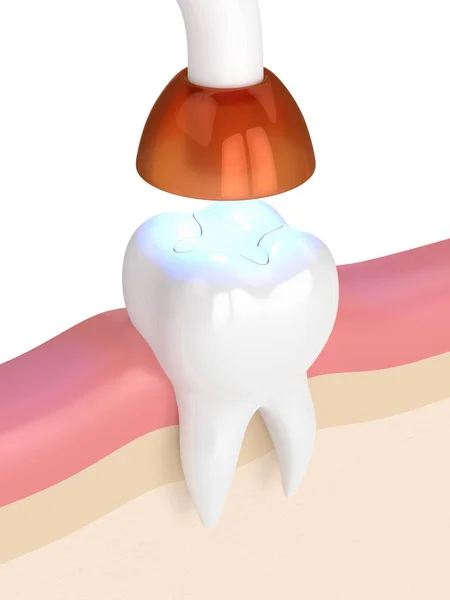 Render Tooth Dental Polymerization Lamp Light Cured Inlay Filling White — Stock Photo, Image