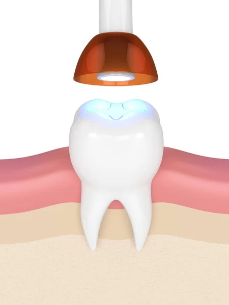 3d render of tooth with dental polymerization lamp and light cured inlay filling over white background