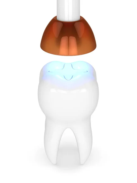 Vykreslování Zubu Dentální Polymerizační Lampy Světla Uzená Vložka Plnění Nad — Stock fotografie
