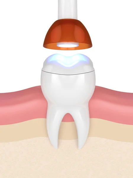 3d render of tooth with dental polymerization lamp and light cured onlay filling over white background