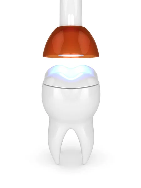 Рендеринг Зуба Помощью Лампы Полимеризации Зубов Света Вылечить Onlay Заполнения — стоковое фото