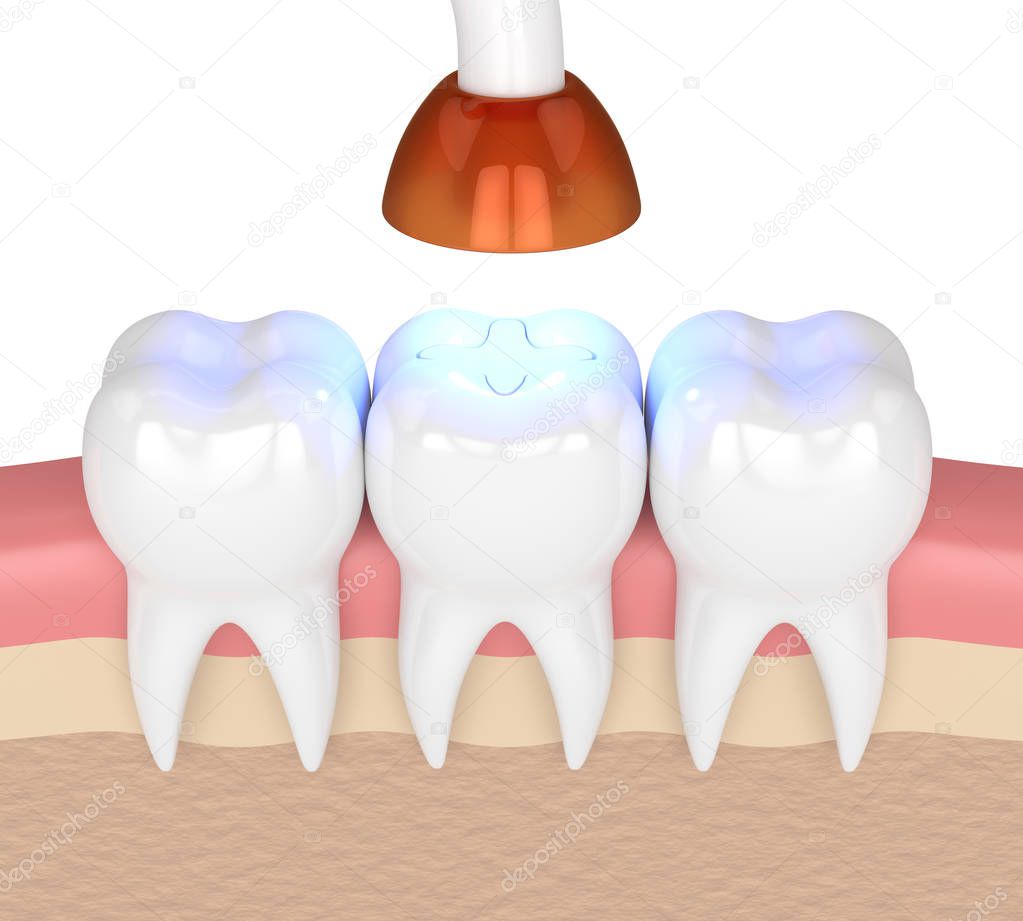 3d render of teeth with dental polymerization lamp and light cured inlay filling over white background