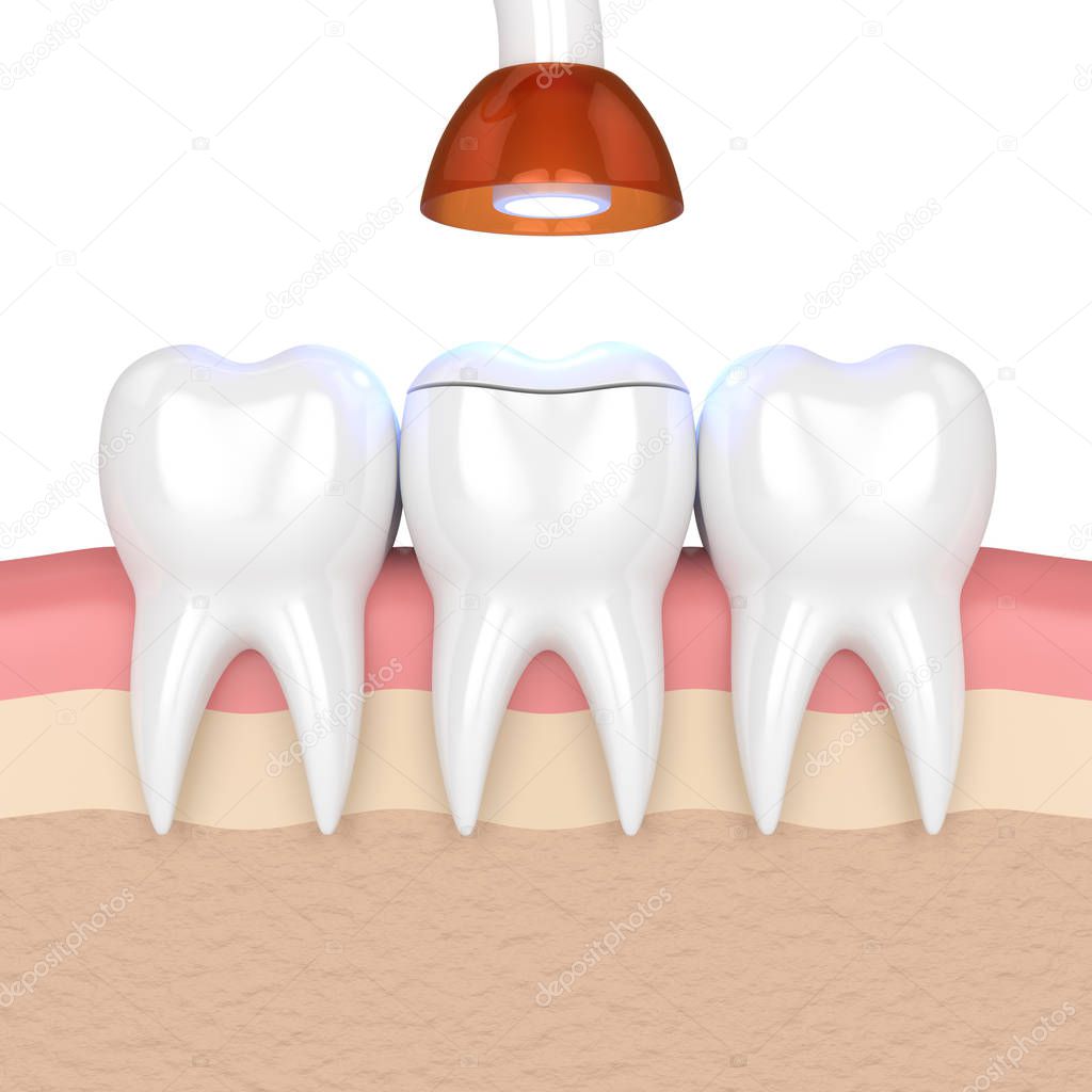 3d render of teeth with dental polymerization lamp and light cured onlay filling over white background