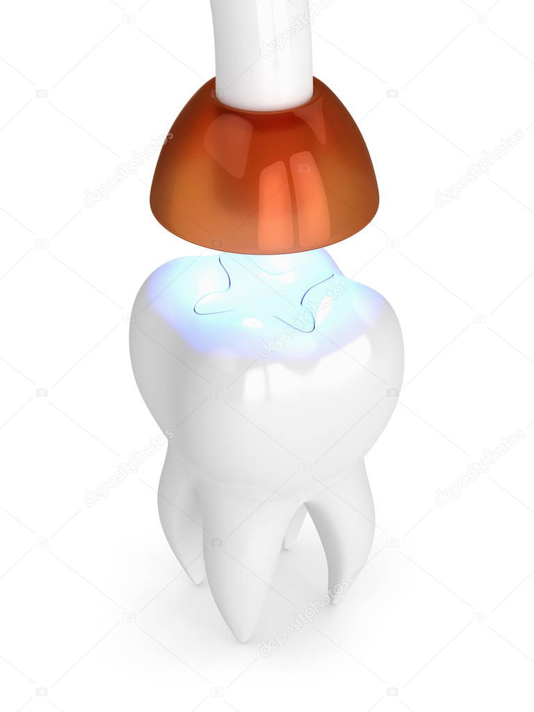 3d render of tooth with dental polymerization lamp and light cured inlay filling over white background
