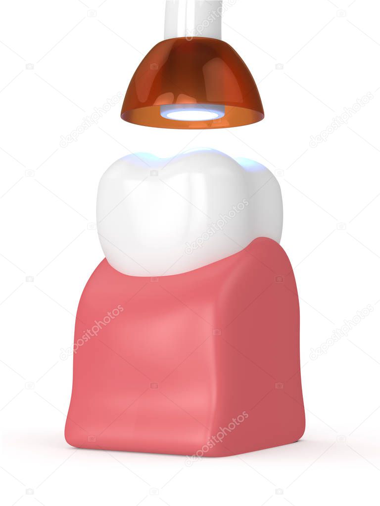 3d render of tooth with dental polymerization lamp and light cured inlay filling over white background