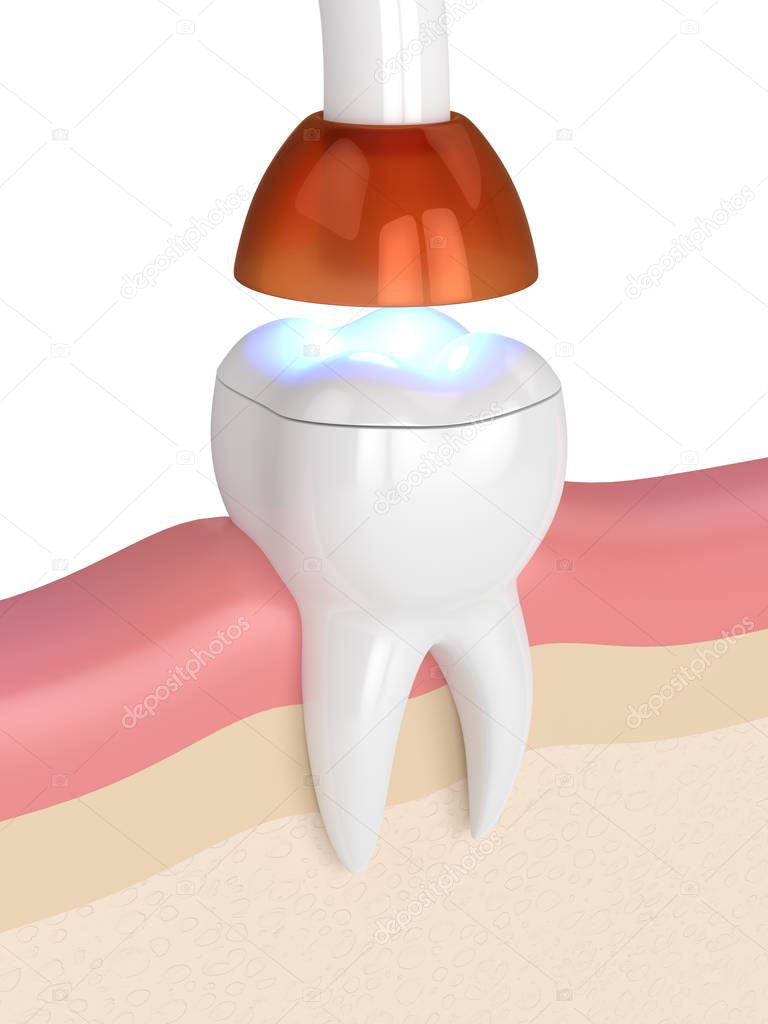 3d render of tooth with dental polymerization lamp and light cured onlay filling over white background